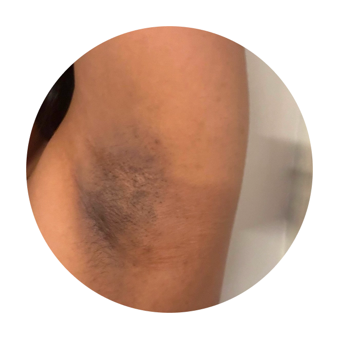 Reduce Dark Spots from Underarms